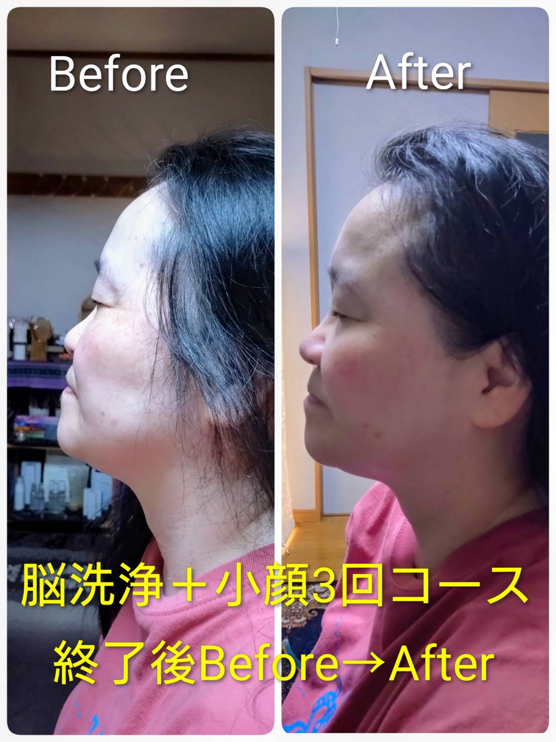 脳洗浄＋小顔3回コース ビフォーアフター