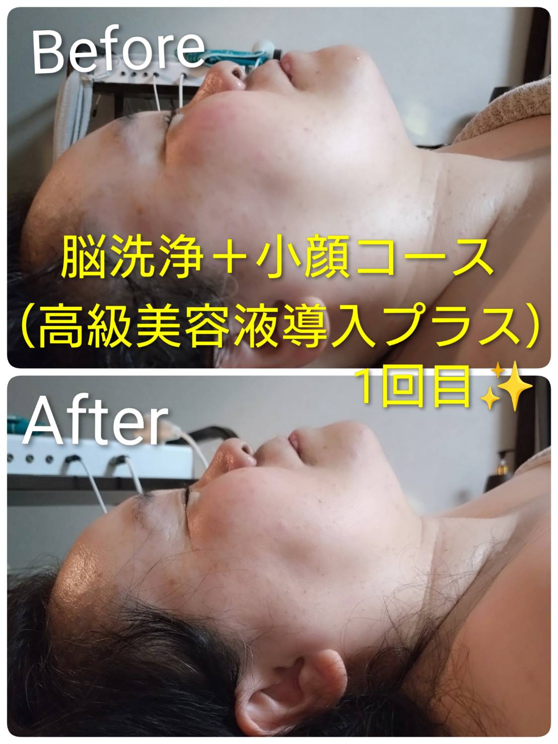 脳洗浄＋小顔コース（高級美容液導入＋）1回目 ビフォーアフター